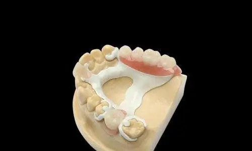 Peek Framework Offers Metal-Free Alternatives for Dental Laboratories